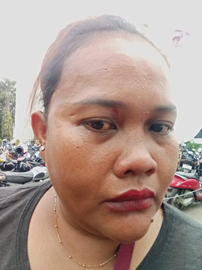 Tia sebagai korban dan pelapor, terlihat mata kanan bengkak